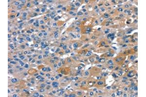 The image on the left is immunohistochemistry of paraffin-embedded Human liver cancer tissue using ABIN7130906(RNF7 Antibody) at dilution 1/20, on the right is treated with fusion protein. (RNF7 抗体)
