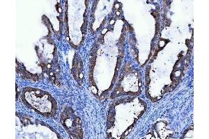 IHC analysis of TRK fused gene/TFG using anti-TRK fused gene/TFG antibody (ABIN7599839). (TFG 抗体  (AA 121-400))