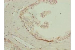 Immunohistochemistry of paraffin-embedded human prostate cancer using ABIN7158732 at dilution of 1:100 (LYSMD1 抗体  (AA 1-227))