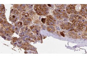 ABIN6273892 at 1/100 staining Human liver cancer tissue by IHC-P. (GPR77 抗体  (C-Term))