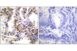 Immunohistochemistry analysis of paraffin-embedded human lung carcinoma tissue, using 4E-BP1 (Ab-36) Antibody. (eIF4EBP1 抗体  (AA 2-51))