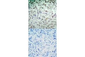 Immunohistochemical staining of human breast cancer tissue by RB1 (phospho S780) polyclonal antibody  without blocking peptide (A) or preincubated with blocking peptide (B) under 1:50-1:100 dilution. (Retinoblastoma 1 抗体  (pSer780))