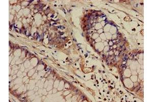 Immunohistochemistry of paraffin-embedded human colon cancer using ABIN7175830 at dilution of 1:100 (WASF1 抗体  (AA 381-553))