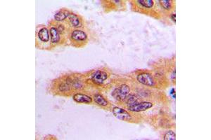 Immunohistochemical analysis of BCKDK staining in human liver cancer formalin fixed paraffin embedded tissue section. (BCKDK 抗体  (N-Term))
