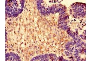 Immunohistochemistry of paraffin-embedded human ovarian cancer using ABIN7142792 at dilution of 1:100 (RPL28 抗体  (AA 2-137))
