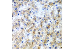 Immunohistochemistry of paraffin-embedded human liver cancer using LY86 antibody. (LY86 抗体)