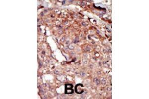 Formalin-fixed and paraffin-embedded human cancer tissue reacted with BRD2 polyclonal antibody  , which was peroxidase-conjugated to the secondary antibody, followed by AEC staining. (BRD2 抗体  (Internal Region))