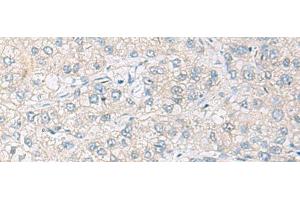 Immunohistochemistry of paraffin-embedded Human liver cancer tissue using FARP2 Polyclonal Antibody at dilution of 1:70(x200) (FARP2 抗体)
