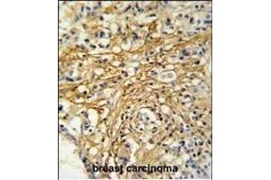 DC13 Antibody (N-term) (ABIN651108 and ABIN2840074) IHC analysis in formalin fixed and paraffin embedded human breast carcinoma followed by peroxidase conjugation of the secondary antibody and DAB staining. (C16orf61 抗体  (N-Term))