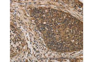 Immunohistochemistry of Human colon cancer using DACH1 Polyclonal Antibody at dilution of 1:50 (DACH1 抗体)