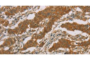 Immunohistochemistry of paraffin-embedded Human gasrtic cancer tissue using CYP39A1 Polyclonal Antibody at dilution 1:50 (CYP39A1 抗体)