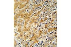 Immunohistochemistry analysis in formalin fixed and paraffin embedded human hepatocarcinoma reacted with NUSAP1 / ANKT Antibody (N-term) followed by peroxidase conjugation of the secondary antibody and DAB staining. (NUSAP1 抗体  (N-Term))