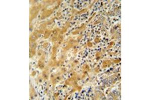 Immunohistochemistry analysis in formalin fixed and paraffin embedded human hepatocarcinoma reacted with NUSAP1 / ANKT Antibody (N-term) followed by peroxidase conjugation of the secondary antibody and DAB staining.