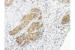 Phospho-Transferrin Receptor (Tyr20) Antibody at 1/100 staining Human ovarian cancer by IHC-P. (Transferrin Receptor 抗体  (pTyr20))