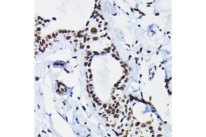 Immunohistochemistry of paraffin-embedded human breast cancer using HDGF Rabbit pAb  at dilution of 1:50 (40x lens). (HDGF 抗体  (AA 1-240))