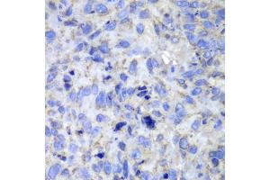 Immunohistochemistry of paraffin-embedded human lung cancer using CASP7 antibody (ABIN5970716) at dilution of 1/100 (40x lens). (Caspase 7 抗体)