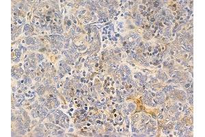 ABIN6265724 and ABIN6266700 at 1/100 staining human thymoma by IHC-P. (MID1 抗体  (N-Term))