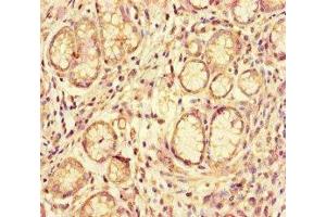 Immunohistochemistry of paraffin-embedded human gastric cancer using ABIN7144126 at dilution of 1:100 (ACE2 抗体  (AA 395-638))