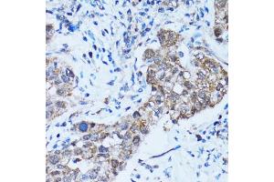 Immunohistochemistry of paraffin-embedded human lung cancer using CASP3 antibody (ABIN5997372) at dilution of 1/100 (40x lens). (Caspase 3 抗体)