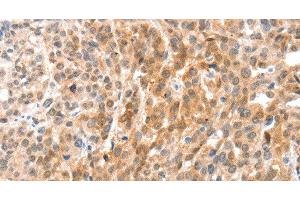 Immunohistochemistry of paraffin-embedded Human esophagus cancer using ANXA8 Polyclonal Antibody at dilution of 1:35 (Annexin VIII 抗体)