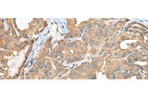 Immunohistochemistry of paraffin-embedded Human thyroid cancer tissue using CA6 Polyclonal Antibody at dilution of 1:35(x200) (CA6 抗体)