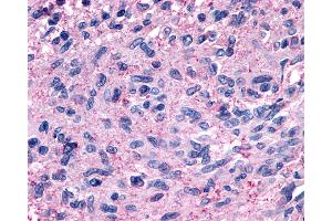 Anti-GPR139 antibody IHC of human Brain, Glioblastoma. (GPR139 抗体  (Cytoplasmic Domain))