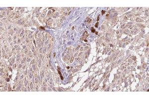 ABIN6274983 at 1/100 staining Human Melanoma tissue by IHC-P. (CGREF1 抗体  (C-Term))