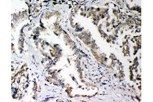 Anti-PLK2 antibody, IHC(P) IHC(P): Human Lung Cancer Tissue (PLK2 抗体  (C-Term))