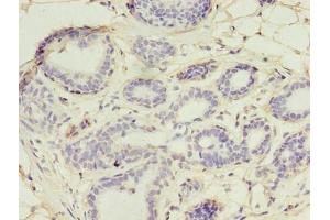 Immunohistochemistry of paraffin-embedded human breast cancer using ABIN7174434 at dilution of 1:100 (UBE2D1 抗体  (AA 1-147))