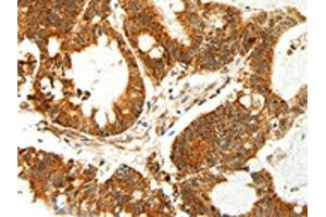 The image on the left is immunohistochemistry of paraffin-embedded Human colon cancer tissue using ABIN7129018(COX7B Antibody) at dilution 1/60, on the right is treated with fusion protein. (COX7B 抗体)