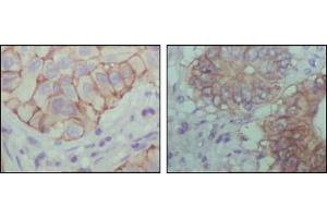Immunohistochemical analysis of paraffin-embedded human lung cancer (left) and colon cancer (right) showing cytoplasmic localization with DAB staining using EphB1 mouse mAb. (EhpB1 (AA 19-133) 抗体)