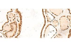 Immunohistochemistry of paraffin-embedded Human thyroid cancer tissue using RMND5B Polyclonal Antibody at dilution of 1:50(x200) (RMND5B 抗体)