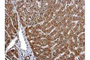 IHC-P Image BMPR1B antibody [N3C3] detects BMPR1B protein at cytosol on human hepatoma by immunohistochemical analysis.