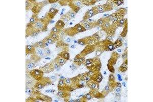Immunohistochemical analysis of AARS2 staining in human liver cancer formalin fixed paraffin embedded tissue section. (AARS2 抗体)