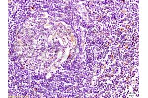 Formalin-fixed human pancreatic cancer tissue labeled with Anti-HLA DMβ Polyclonal Antibody, Unconjugated  at 1:200 followed by conjugation to the secondary antibody and DAB staining (CD74 抗体  (AA 201-296))