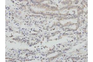 IHC-P Image Immunohistochemical analysis of paraffin-embedded human gastric cancer, using AIF, antibody at 1:100 dilution.