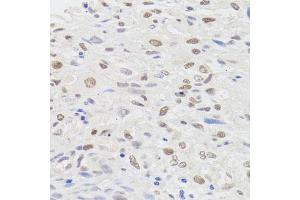 Immunohistochemistry of paraffin-embedded human lung cancer using HMGN1 antibody (ABIN5975005) at dilution of 1/100 (40x lens).