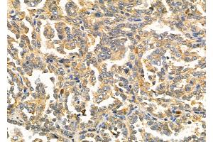 ABIN6257757 and ABIN6275874 at 1/100 staining Human kidney cancer by IHC-P. (LY75/DEC-205 抗体  (Internal Region))