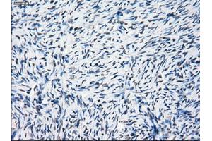 Immunohistochemical staining of paraffin-embedded Adenocarcinoma of breast tissue using anti-PRKY mouse monoclonal antibody. (PRKY 抗体)