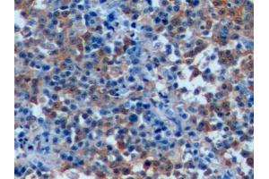 Detection of STMN1 in Human Lymphoma Tissue using Polyclonal Antibody to Stathmin 1 (STMN1) (Stathmin 1 抗体  (AA 2-149))