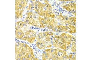 Immunohistochemistry of paraffin-embedded human liver cancer using CYP2E1 antibody at dilution of 1:100 (x400 lens). (CYP2E1 抗体)