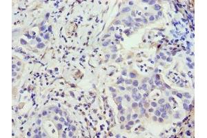 Immunohistochemistry of paraffin-embedded human bladder cancer using ABIN7176493 at dilution of 1:100 (ZNF643 抗体  (AA 15-310))