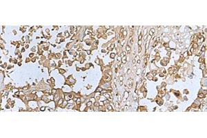 Immunohistochemistry of paraffin-embedded Human colorectal cancer tissue using TREM1 Polyclonal Antibody at dilution of 1:50(x200) (TREM1 抗体)