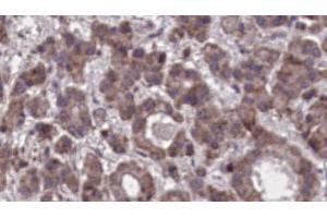 ABIN6273905 at 1/100 staining Human liver cancer tissue by IHC-P. (GPR97 抗体  (N-Term))
