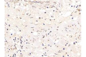 Detection of AR in Human Endometrial cancer Tissue using Polyclonal Antibody to Androgen Receptor (AR) (Androgen Receptor 抗体  (AA 15-246))