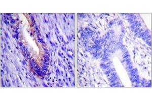 Immunohistochemistry analysis of paraffin-embedded human colon carcinoma tissue, using eIF4G (Ab-1108) Antibody. (EIF4G1 抗体  (AA 1074-1123))