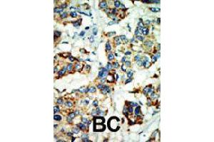 Formalin-fixed and paraffin-embedded human cancer tissue reacted with NEK4 polyclonal antibody  , which was peroxidase-conjugated to the secondary antibody, followed by AEC staining. (NEK4 抗体  (C-Term))