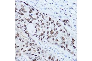 Immunohistochemistry of paraffin-embedded human breast cancer using SSB Rabbit pAb (ABIN3015264, ABIN3015265, ABIN3015266 and ABIN6213909) at dilution of 1:300 (40x lens). (SSB 抗体  (AA 166-408))