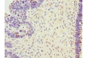 Immunohistochemistry of paraffin-embedded human ovarian cancer using ABIN7168591 at dilution of 1:100 (SAP30BP 抗体  (AA 1-308))