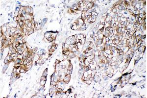 Anti-VE Cadherin antibody, IHC(P) IHC(P): Human Lung Cancer Tissue (Cadherin 5 抗体  (C-Term))